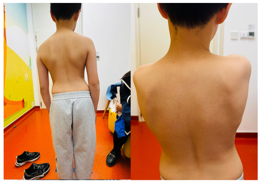 世界脊柱健康日| 10岁男孩侧弯13.9°→3个月重回中立位！这些信号